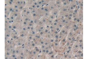 DAB staining on IHC-P; Samples: Human Liver cancer Tissue (RNASE1 抗体  (AA 29-156))
