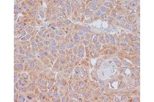 Immunohistochemical analysis of paraffin-embedded human lung cancer, using ATG9A Antibody. (Recombinant ATG9A 抗体)