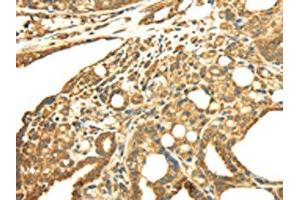 The image on the left is immunohistochemistry of paraffin-embedded Human thyroid cancer tissue using ABIN7128021(SRPRB Antibody) at dilution 1/30, on the right is treated with fusion protein. (SRPRB 抗体)