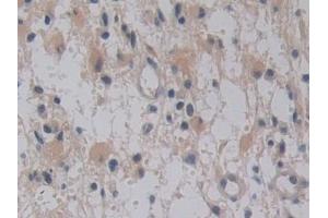 Detection of TMPRSS4 in Human Glioma Tissue using Polyclonal Antibody to Transmembrane Protease, Serine 4 (TMPRSS4)