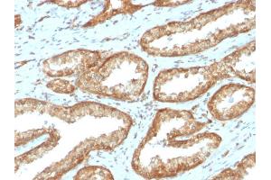 Formalin-fixed, paraffin-embedded human Prostate Carcinoma stained with YBX1 Mouse Recombinant Monoclonal Antibody (rYBX1/2430). (Recombinant YBX1 抗体)