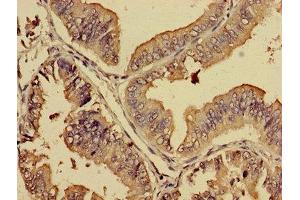 Immunohistochemistry of paraffin-embedded human endometrial cancer using ABIN7164730 at dilution of 1:100 (PREB 抗体  (AA 98-283))