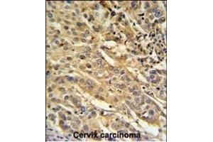 F91A1 Antibody (N-term) (ABIN651217 and ABIN2840136) IHC analysis in formalin fixed and paraffin embedded human cervix carcinoma followed by peroxidase conjugation of the secondary antibody and DAB staining. (FAM91A1 抗体  (N-Term))