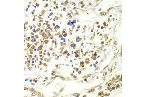 Immunohistochemistry of paraffin-embedded human liver cancer using UPF1 antibody. (RENT1/UPF1 抗体  (AA 270-370))