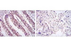 Immunohistochemical analysis of paraffin-embedded rectum cancer tissues (left) and placenta tissues (right) using CDK9 mouse mAb with DAB staining. (CDK9 抗体)