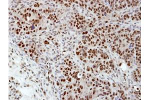 IHC-P Image Immunohistochemical analysis of paraffin-embedded NCIN87 xenograft, using hnRNP H, antibody at 1:100 dilution. (HNRNPH1 抗体)