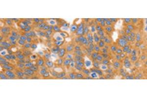 Immunohistochemistry of paraffin-embedded Human ovarian cancer tissue using MYOD1 Polyclonal Antibody at dilution of 1:120(x200) (MYOD1 抗体)