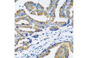 Immunohistochemistry of paraffin-embedded human gastric cancer using NFKB1 antibody (ABIN6292205) at dilution of 1:100 (40x lens). (NFKB1 抗体)