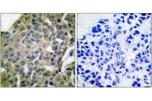 Immunohistochemistry analysis of paraffin-embedded human breast carcinoma tissue, using GRP94 Antibody. (GRP94 抗体  (AA 754-803))