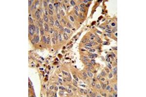 Formalin-fixed and paraffin-embedded human lung carcinoma reacted with Peroxin 16 / PEX16 Antibody (Center) followed which was peroxidase-conjugated to the secondary antibody, followed by DAB staining. (PEX16 抗体  (Middle Region))