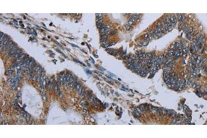 Immunohistochemistry of paraffin-embedded Human colon cancer using NDUFA13 Polyclonal Antibody at dilution of 1:50 (NDUFA13 抗体)