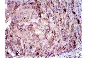 Immunohistochemical analysis of paraffin-embedded liver cancer tissues using CRP mouse mAb with DAB staining. (CRP 抗体)