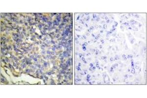 Immunohistochemistry analysis of paraffin-embedded human breast carcinoma tissue, using DFFA Antibody. (DFFA 抗体  (AA 151-200))