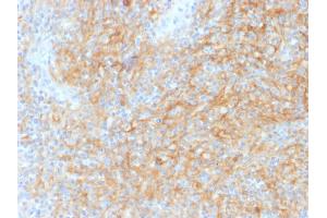 Formalin-fixed, paraffin-embedded human Hodgkins Lymphoma stained with CD40 Mouse Monoclonal Antibody (C40/1605). (CD40 抗体)