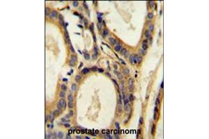 CCL4 Antibody immunohistochemistry analysis in formalin fixed and paraffin embedded human prostate carcinoma followed by peroxidase conjugation of the secondary antibody and DAB staining. (CCL4 抗体  (AA 22-48))
