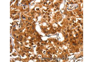 Immunohistochemistry of Human lung cancer using ADAP1 Polyclonal Antibody at dilution of 1:60 (ADAP1 抗体)