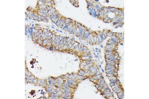Immunohistochemistry of paraffin-embedded human colon carcinoma using MT-CYB antibody (ABIN7268595) at dilution of 1:100 (40x lens). (Cytochrome b 抗体)