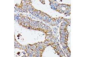 Immunohistochemistry of paraffin-embedded human colon carcinoma using MT-CYB antibody (ABIN7268595) at dilution of 1:100 (40x lens).