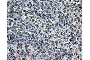 Immunohistochemical staining of paraffin-embedded Adenocarcinoma of ovary tissue N93ing anti-ARNT mouse monoclonal antibody. (ARNT 抗体)