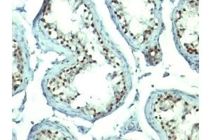 Formalin-fixed, paraffin-embedded human testicular carcinoma stained with Nucleolin antibody. (Nucleolin 抗体)