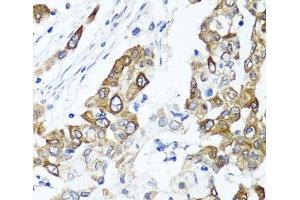 Immunohistochemistry of paraffin-embedded Human colon carcinoma using PPOX Polyclonal Antibody at dilution of 1:100 (40x lens). (PPOX 抗体)