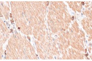 Immunohistochemistry of paraffin-embedded Human gastric cancer using ABCB7 Polyclonal Antibody at dilution of 1:100 (40x lens). (ABCB7 抗体)