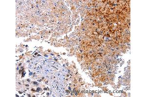 Immunohistochemistry of Human lung cancer using HMOX1 Polyclonal Antibody at dilution of 1:40 (HMOX1 抗体)
