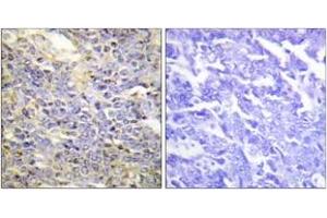 Immunohistochemistry analysis of paraffin-embedded human lung carcinoma tissue, using Caspase 9 (Ab-125) Antibody. (Caspase 9 抗体  (AA 91-140))