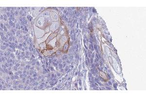 ABIN6279758 at 1/100 staining Human Head and neck cancer tissue by IHC-P. (RGS21 抗体  (N-Term))