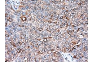 Immunohistochemical staining of paraffin-embedded Adenocarcinoma of Human colon tissue using anti-TACC3 mouse monoclonal antibody.