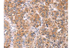 The image on the left is immunohistochemistry of paraffin-embedded Human liver cancer tissue using ABIN7191466(MLNR Antibody) at dilution 1/45, on the right is treated with synthetic peptide. (Motilin Receptor 抗体)