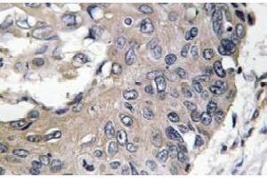 Immunohistochemistry analysis of ApoE Antibody in paraffin-embedded human lung carcinoma tissue. (APOE 抗体)