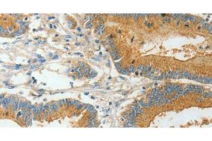 Immunohistochemistry of paraffin-embedded Human colon cancer using BAAT Polyclonal Antibody at dilution of 1:30