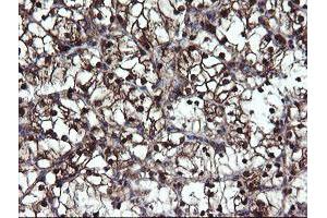 Immunohistochemical staining of paraffin-embedded Carcinoma of Human kidney tissue using anti-MPI mouse monoclonal antibody.