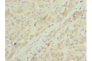 Immunohistochemistry of paraffin-embedded human liver cancer using ABIN7143985 at dilution of 1:100 (Monoamine Oxidase A 抗体  (AA 1-300))