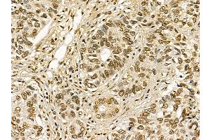 SAF-A2 Mouse Monoclonal Antibody at 1/100 staining human lung cancer and adjacent non-tumor tissue by IHC-P.