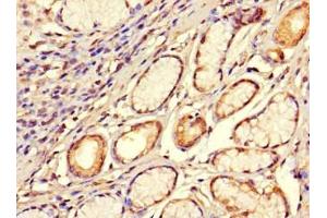 Immunohistochemistry of paraffin-embedded human gastric cancer using ABIN7170420 at dilution of 1:100 (SMOC1 抗体  (AA 277-382))