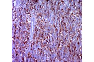 Paraformaldehyde-fixed, paraffin embedded human gastric carcinoma, Antigen retrieval by boiling in sodium citrate buffer (pH6.