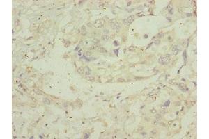 Immunohistochemistry of paraffin-embedded human pancreatic cancer using ABIN7159922 at dilution of 1:100 (MIPEP 抗体  (AA 504-713))
