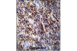 Parp9 Antibody (C-term) (ABIN655613 and ABIN2845094) immunohistochemistry analysis in formalin fixed and paraffin embedded human lymphoma followed by peroxidase conjugation of the secondary antibody and DAB staining. (PARP9 抗体  (AA 599-629))