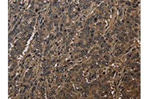 The image on the left is immunohistochemistry of paraffin-embedded Human liver cancer tissue using ABIN7129664(GSTO1 Antibody) at dilution 1/60, on the right is treated with fusion protein. (GSTO1 抗体)