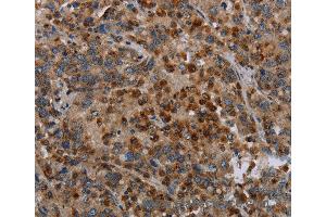 Immunohistochemistry of Human liver cancer using MAP3K11 Polyclonal Antibody at dilution of 1:40 (MAP3K11 抗体)