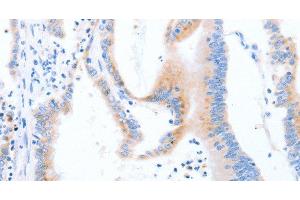 Immunohistochemistry of paraffin-embedded Human colon cancer using STK4 Polyclonal Antibody at dilution of 1:70 (STK4 抗体)