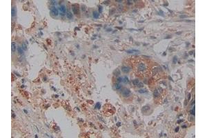 Detection of NGAL in Human Pancreatic cancer Tissue using Polyclonal Antibody to Neutrophil gelatinase-associated lipocalin (NGAL) (Lipocalin 2 抗体  (AA 21-198))