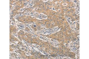 Immunohistochemistry of Human gastric cancer using NFE2L1 Polyclonal Antibody at dilution of 1:30
