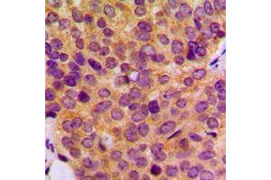 Immunohistochemical analysis of MMP19 staining in human breast cancer formalin fixed paraffin embedded tissue section. (MMP19 抗体  (N-Term))