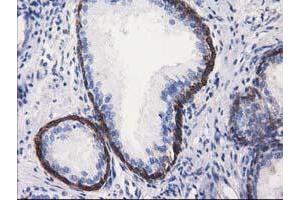 Immunohistochemical staining of paraffin-embedded Carcinoma of Human kidney tissue using anti-ALDH1L1 mouse monoclonal antibody. (ALDH1L1 抗体)