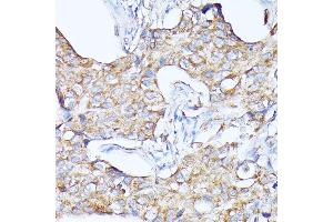 Immunohistochemistry of paraffin-embedded human breast cancer using CTSF antibody (ABIN6127667, ABIN6139225, ABIN6139226 and ABIN6214736) at dilution of 1:100 (40x lens). (Cathepsin F 抗体  (AA 270-484))