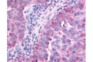 Anti-PAK6 antibody IHC of human Lung, Non-Small Cell Carcinoma. (PAK6 抗体  (Linker Domain))