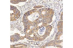 Immunohistochemistry of paraffin embedded human colon cancer using IFIT5 (ABIN7074334) at dilution of 1:500 (200x lens) (IFIT5 抗体)